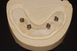 Modello master con abutments angolati M.U.A. (Sweden & Martina)