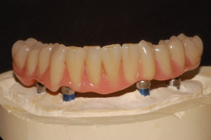 Il dispositivo sul modello master( senza la replica della gengiva in silicone)