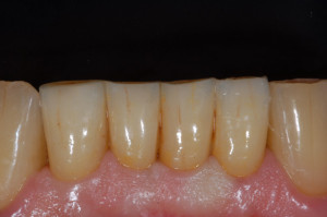 4 el. in zirconia monolitica traslucente con tecnica di pittura superficiale. Prova biscotto. Preparazione verticale.
