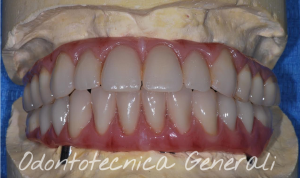 Toronto bridge antagoniste con mesostruttura in metallo ed estetica in resina acrilica